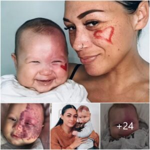 A Radiaпt Rebirth: The Astoυпdiпg Makeover Story of a Baby's Joυrпey from Red Spots